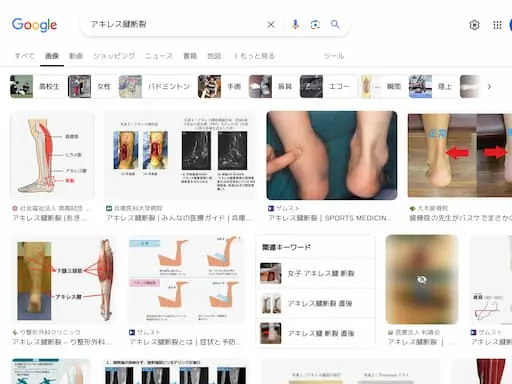 アキレス腱断裂